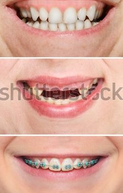 pictures-of-smiles-with-teeth