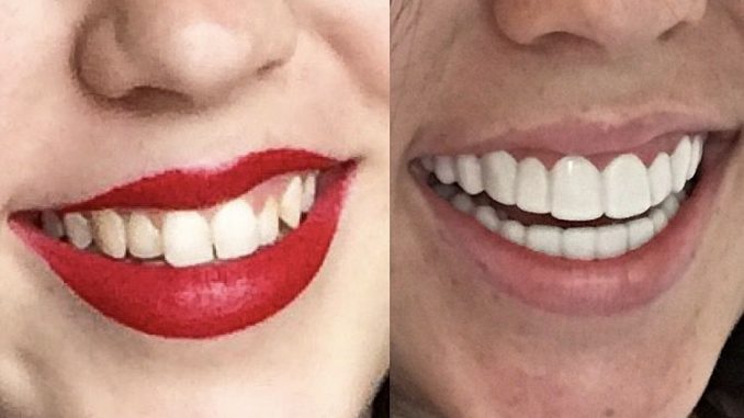 plastic-veneers