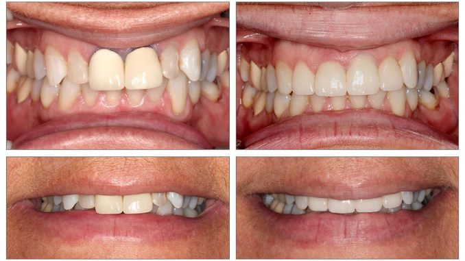 porcelain-crown-before-and-after