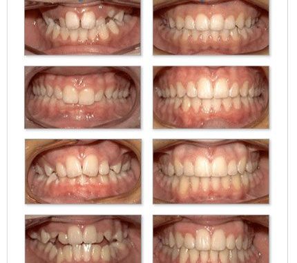 really-bad-teeth-before-and-after