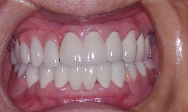 single-tooth-cost-denture