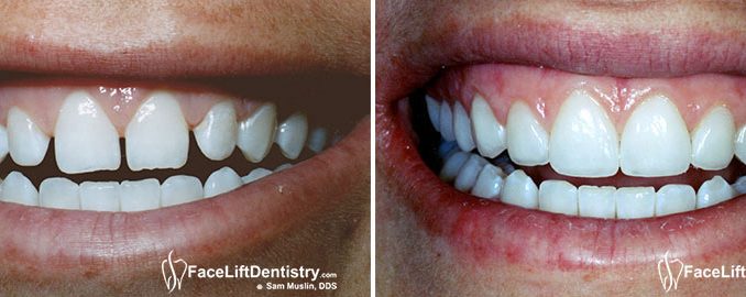 small-teeth-after-braces