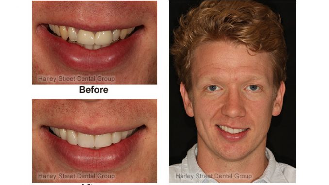 smile-makeovers-before-and-after