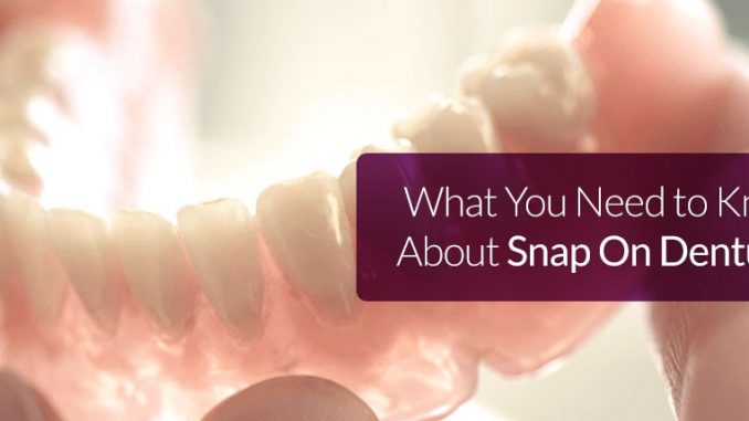 snap-in-dentures-price