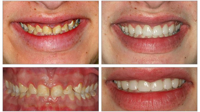 Teeth Cap Before And After Thebrokensealblog 