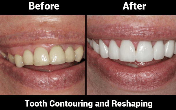 teeth-contouring