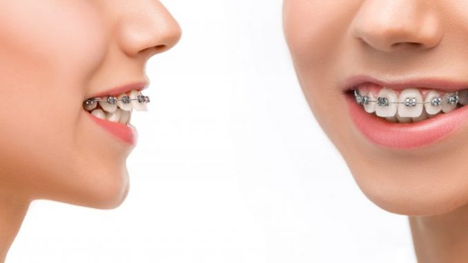 teeth-corrections