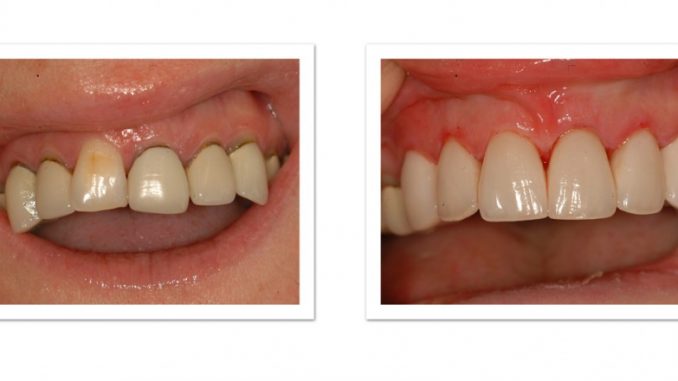 teeth-crowns-cost