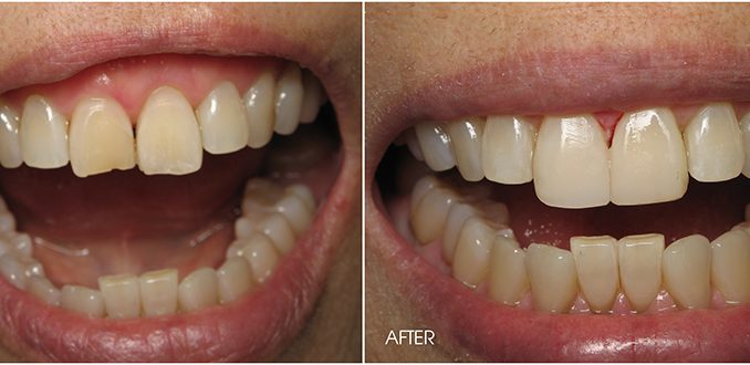 teeth-fixing