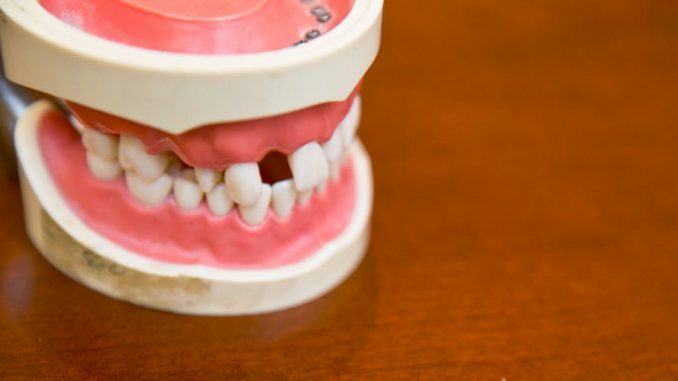 teeth-gap-filling-cost