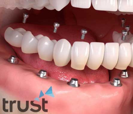 teeth-replacement
