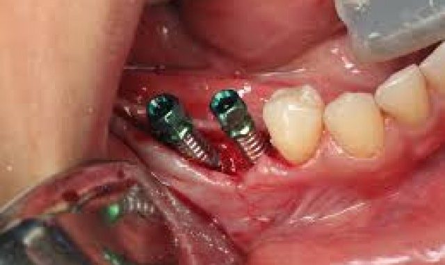 teeth-transplant