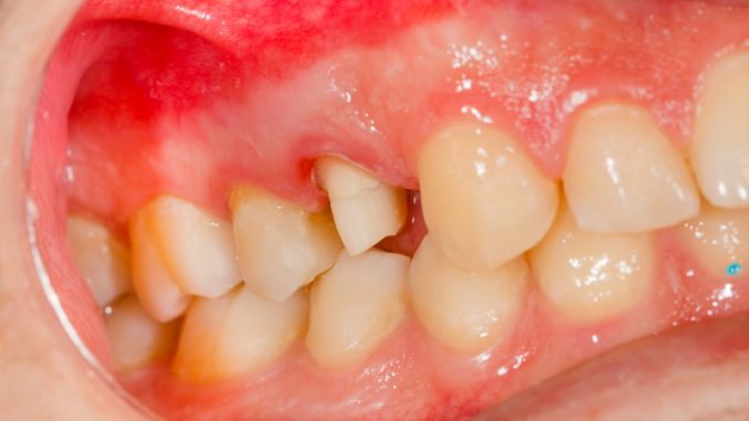 tooth-crown-pain