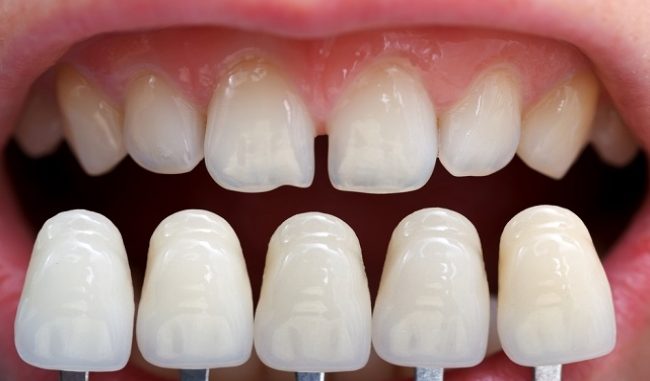 types-of-cosmetic-dentistry