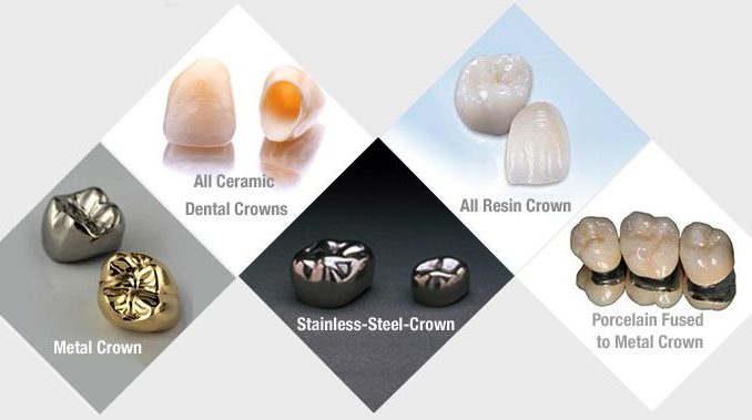 types-of-dental-crown