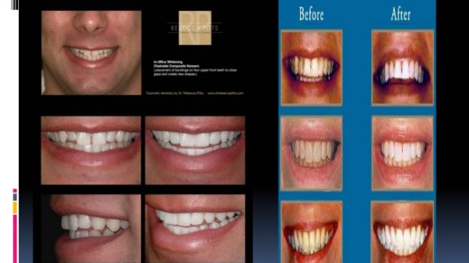 types-of-veneers-teeth