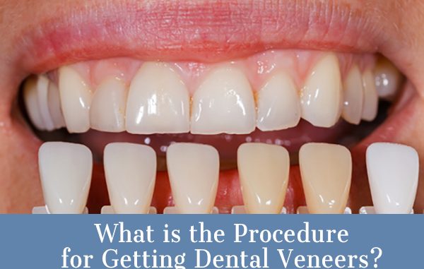 Procedure Veneer Teeth