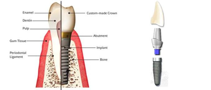 what-is-an-abutment