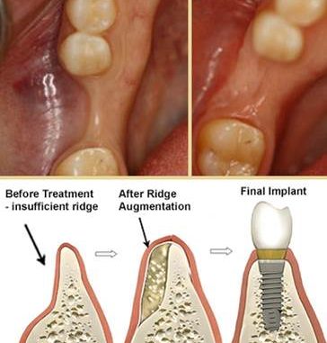 what-to-expect-after-dental-bone-graft
