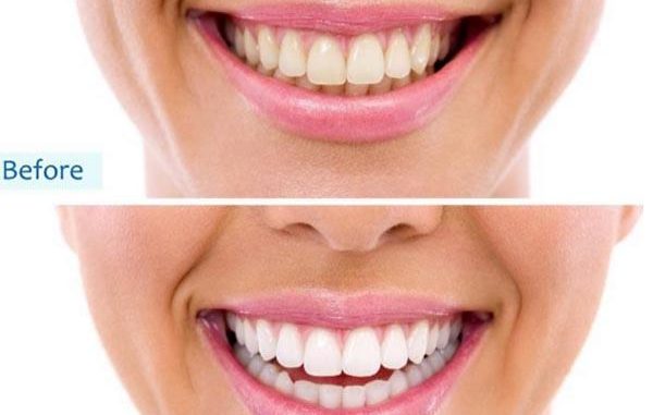 white-smile-dental