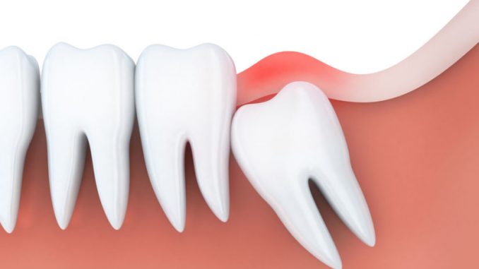 who-removes-wisdom-teeth-what-kind-of-doctor
