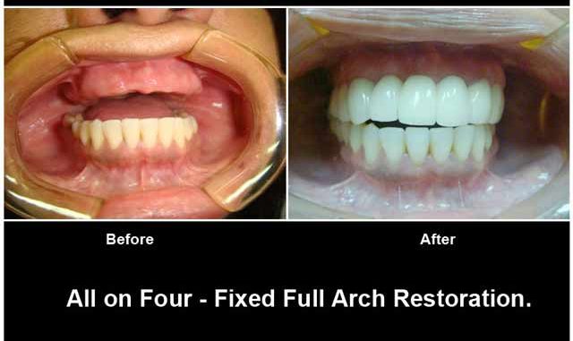 affordable-teeth-implants