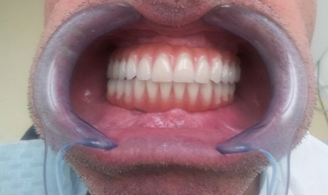 all-on-4-dental-implants