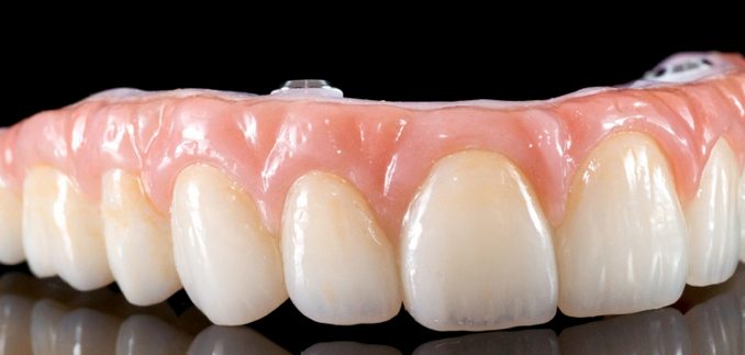 all-on-six-dental-implant-cost