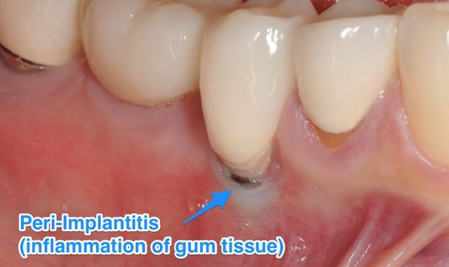 are-dental-implants-painful