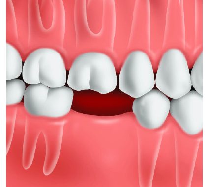 Dental Cost Aspen Implant