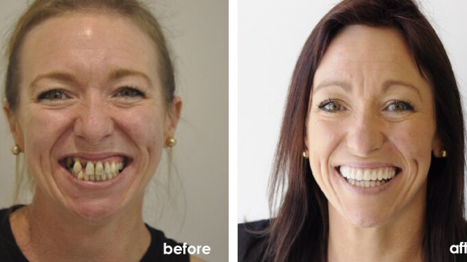 bad-teeth-pictures-before-and-after