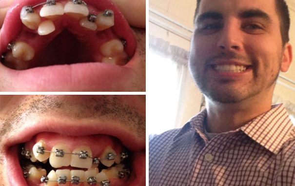 before-and-after-braces-pictures