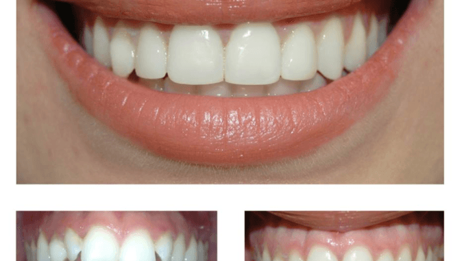 before-and-after-teeth-bonding