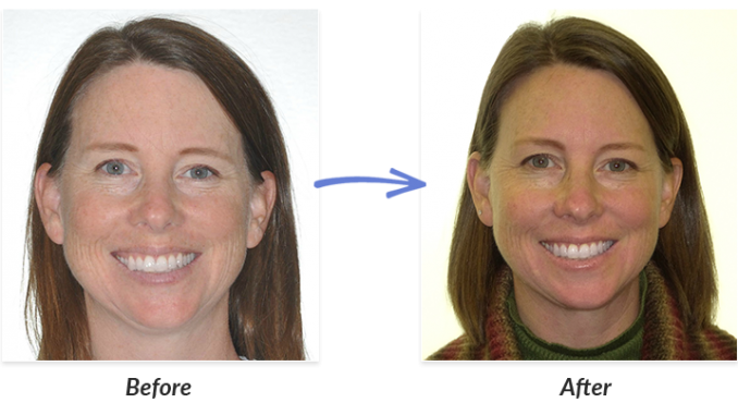 braces-before-and-after-picture