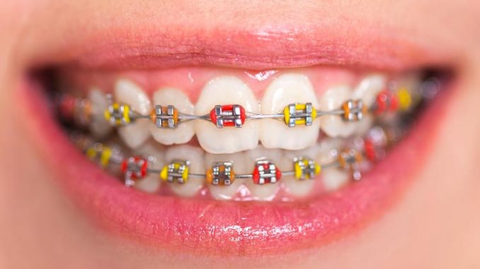 braces-pics