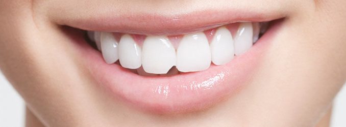 chipped-a-tooth