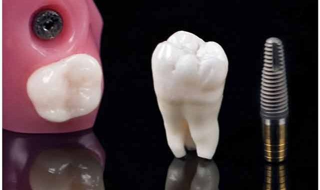 clearchoice-dental-implants-cost