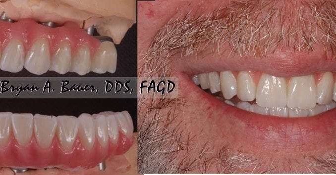 cost-of-implant-supported-dentures