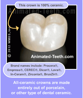 crown-porcelain-ceramic