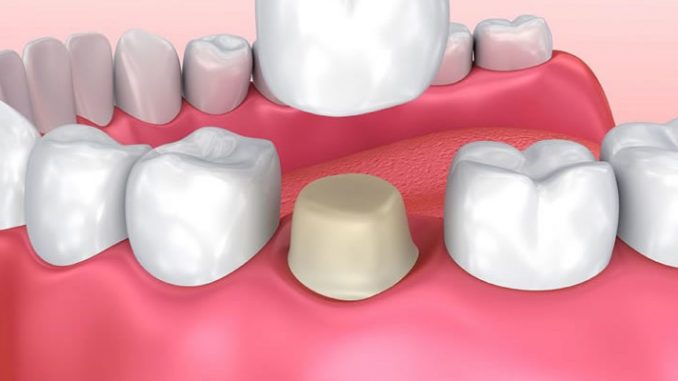 crowns-dental