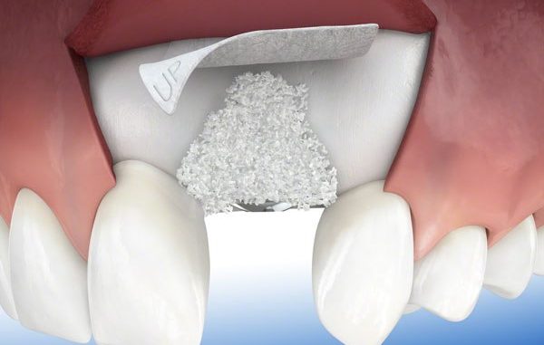 dental-bone-grafting-cost