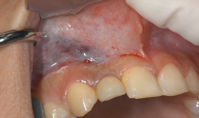 dental-implant-infections