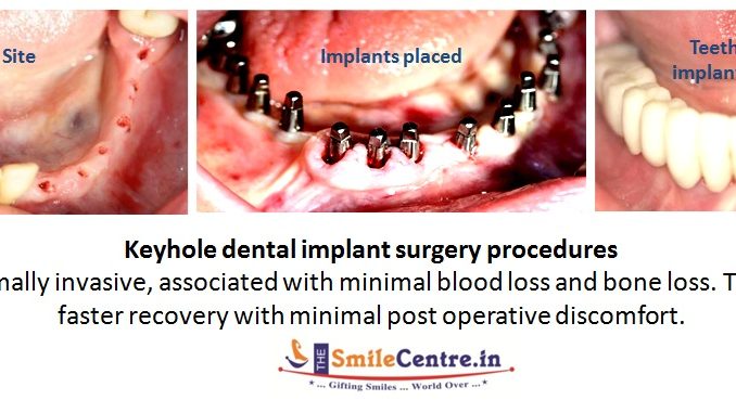 dental-implant-surgery-cost
