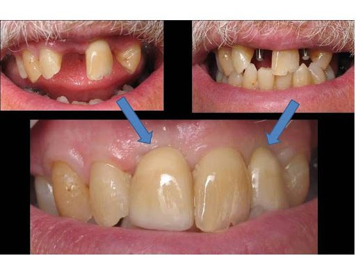 dental-implants-before-and-after