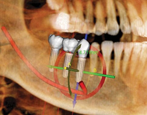 dental-implants-charleston-sc