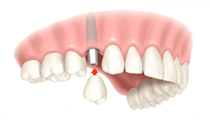 dental-implants-co