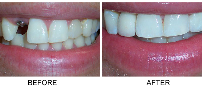 dental-implants-houston