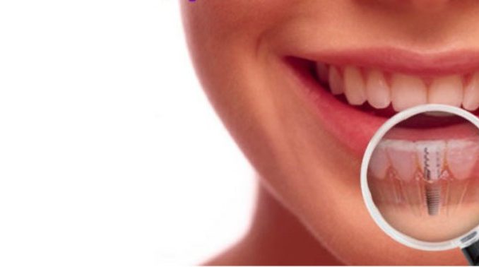 dental-implants-queens