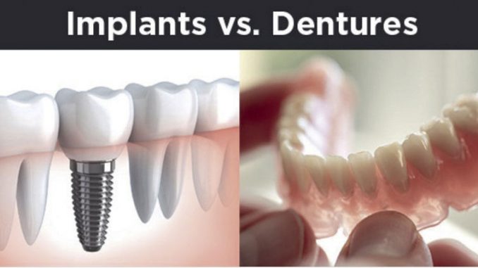 dentures-vs-implants