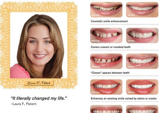 fake-teeth-covers-that-you-can-eat-with